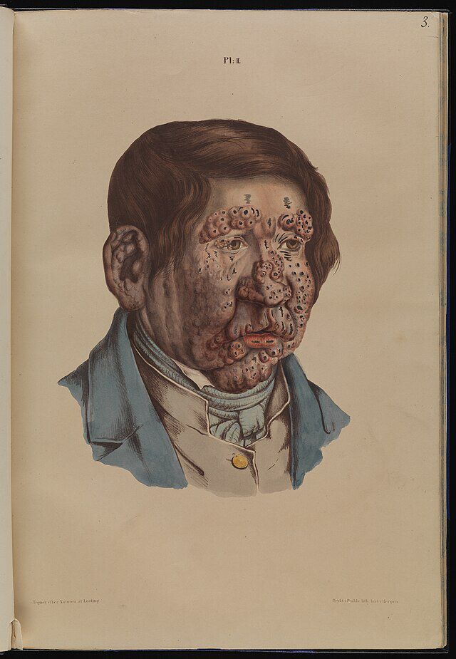 13 år gammel gutt med lepra. Fra Om spedalskhed. Atlas (1847) av Daniel Cornelius Danielssen, Johan Ludvig Losting og Wilhelm Boeck. Wikimedia Commons