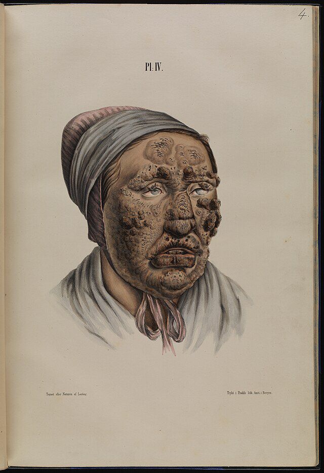28 år gammel kvinne med lepra. Fra Om spedalskhed. Atlas (1847) av Daniel Cornelius Danielssen, Johan Ludvig Losting og Wilhelm Boeck. Wikimedia Commons