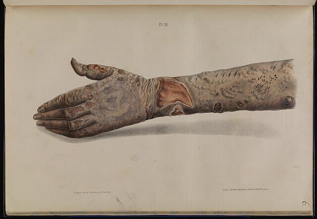 Arm med tuberkulær lepra, Fra Om spedalskhed. Atlas (1847) av Daniel Cornelius Danielssen, Johan Ludvig Losting og Wilhelm Boeck. Wikimedia Commons.