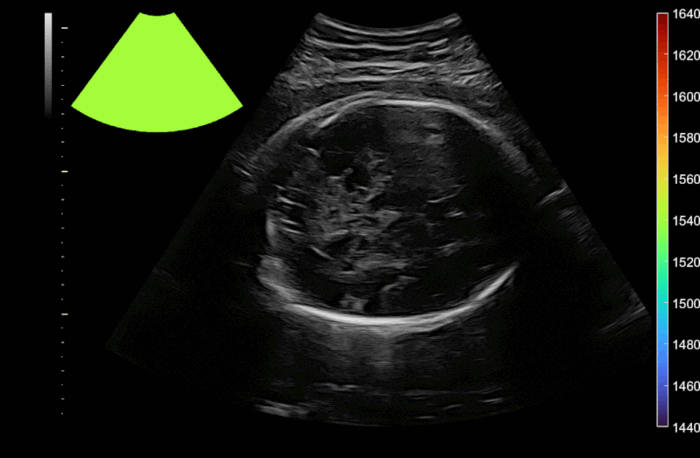 Fetal Ultrasound, Coherence-Based Estimation, Estimating Speed-of-Sound, UltraSound ToolBox (USTB)